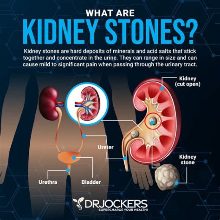 what causes kidney stones drinks
