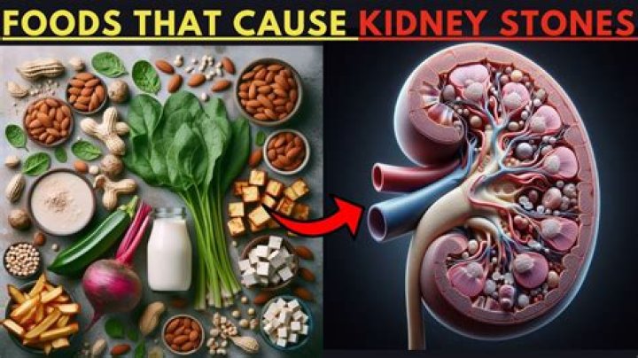 what causes kidney stones food