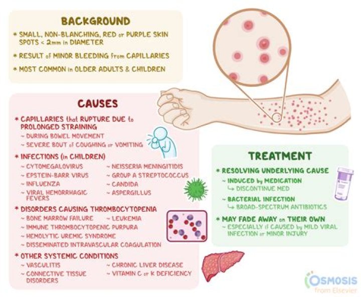 what causes megasphaera