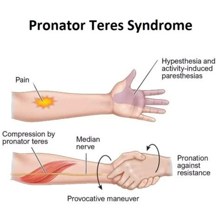 What causes pronator teres syndrome?