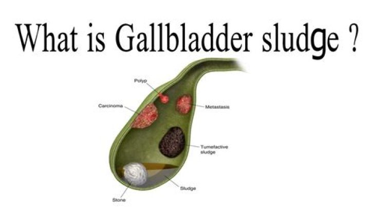 What causes sludge in the gallbladder