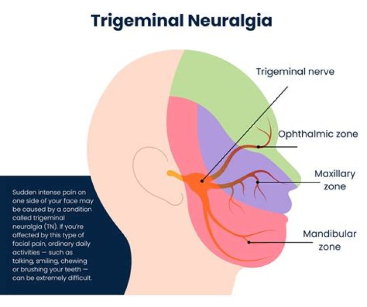 What causes trigeminal dysphoria