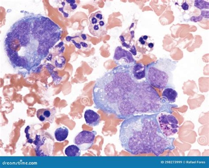 What cells are present in Hodgkins lymphoma