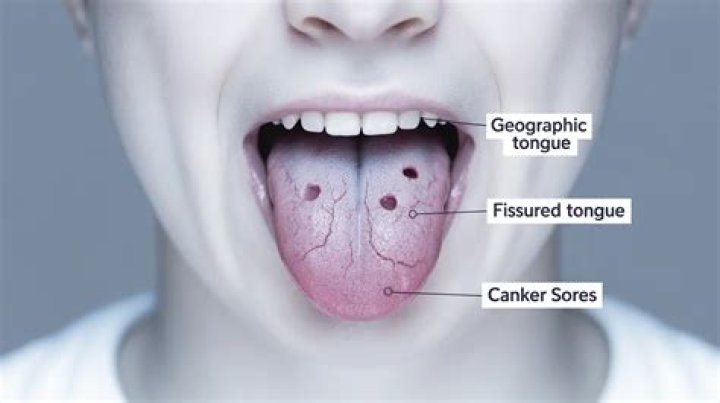 What could spots on your tongue mean?
