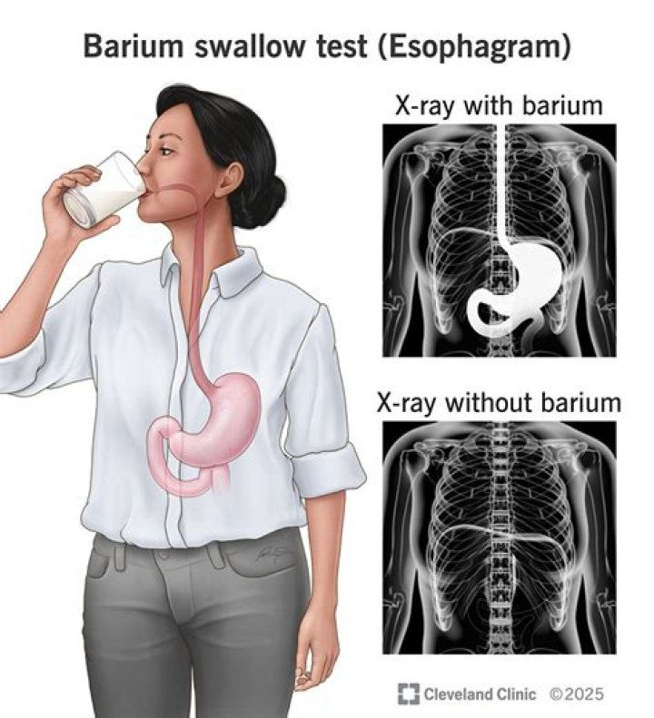 What does a barium Esophagram show