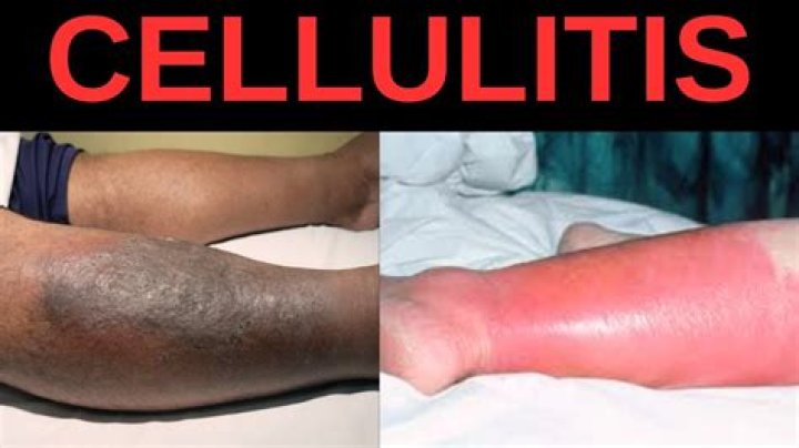What does cellulitis look like on legs
