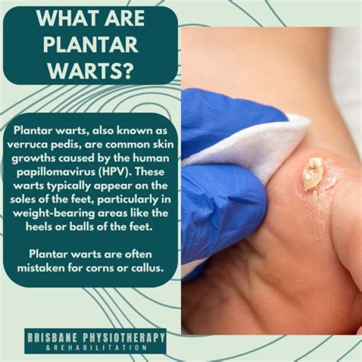 What essential oil gets rid of planters warts