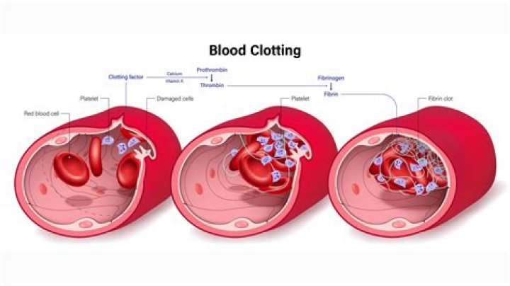 What happens if a blood clot does not dissolve