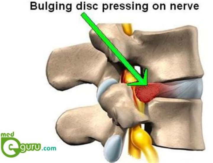 What is a bulging disc in the lower back