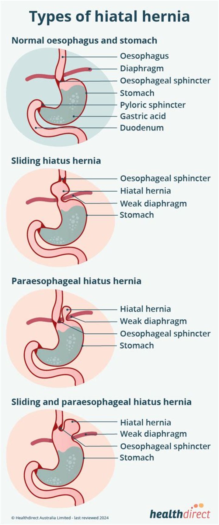 What is a chest wall hernia