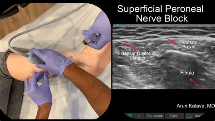 What is a Genitofemoral nerve block