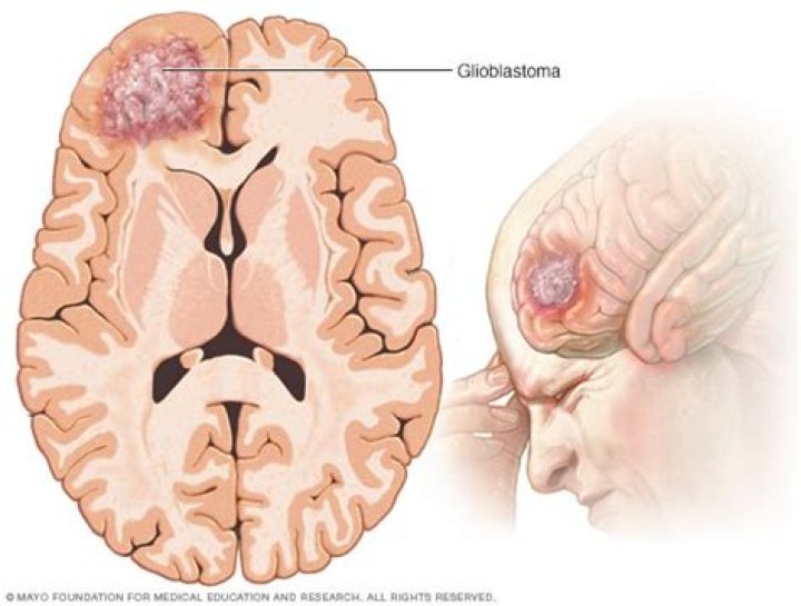 What is a oligodendroglioma tumor