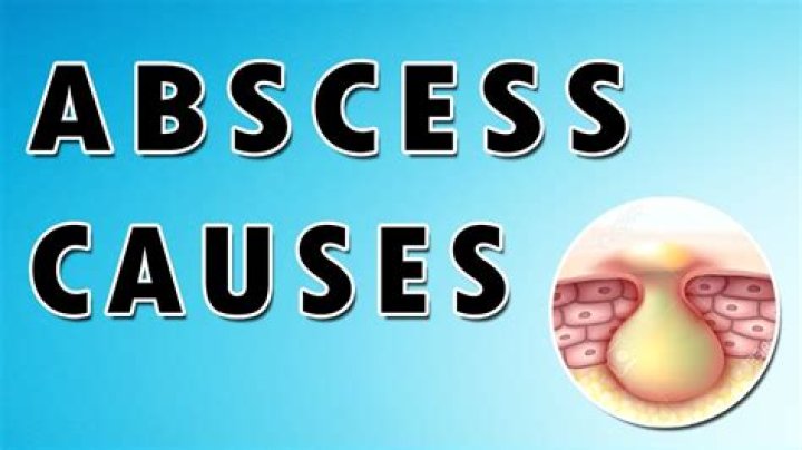 What is an abscess in your stomach