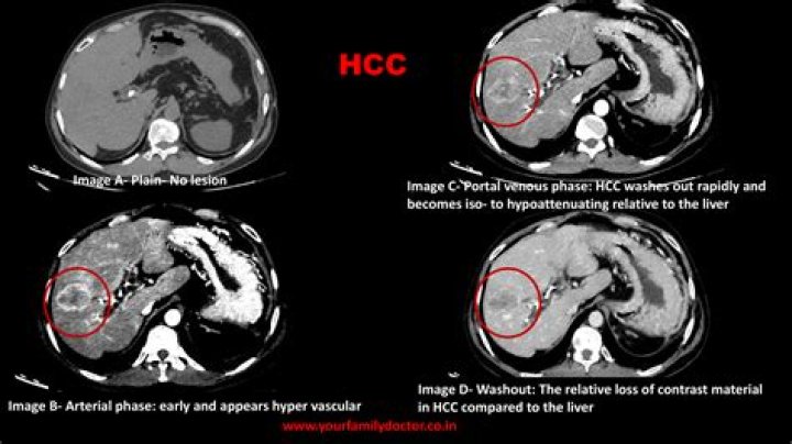 What is an HCC diagnosis