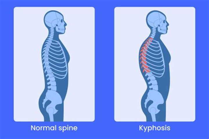 What is angular kyphosis