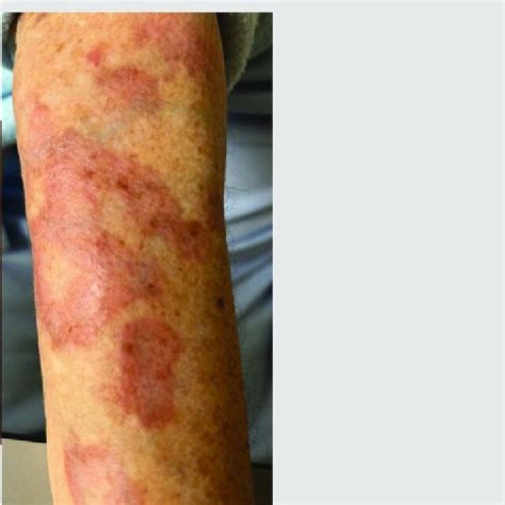 What is annular rash