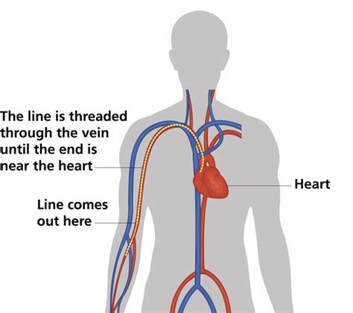 What is central line placement