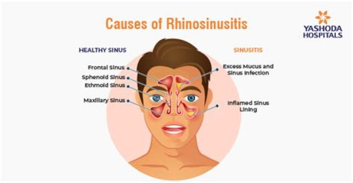 What is chronic rhinosinusitis