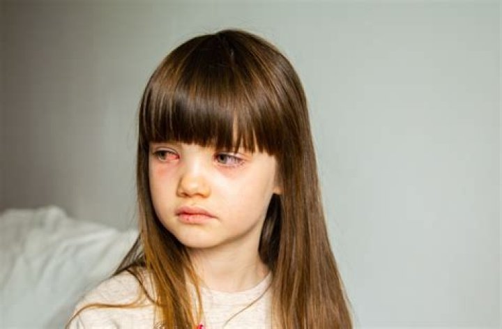 what is commonly misdiagnosed as pink eye
