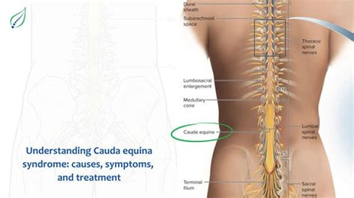 What is Conus and cauda equina
