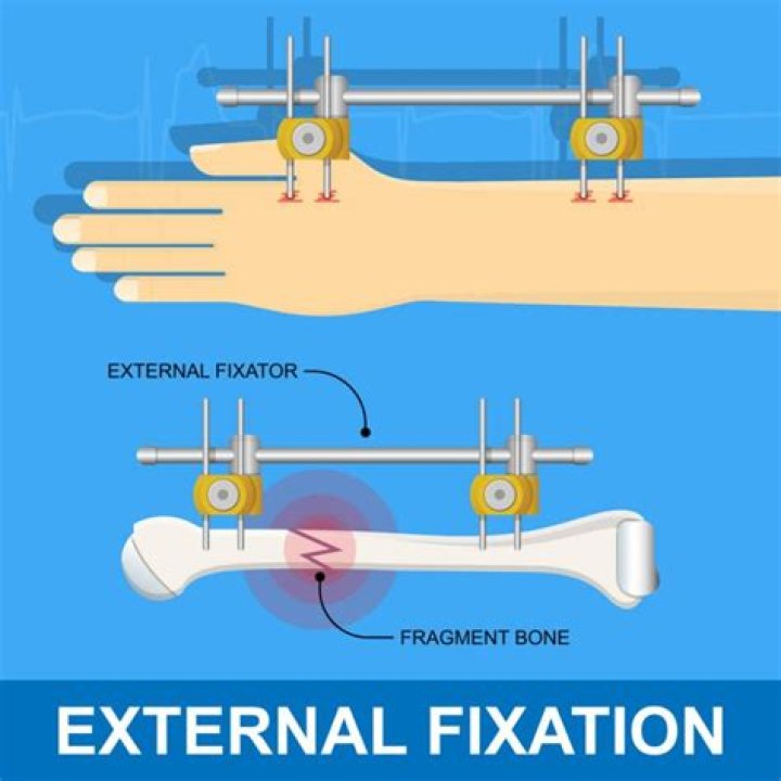 What is external fixation used for?