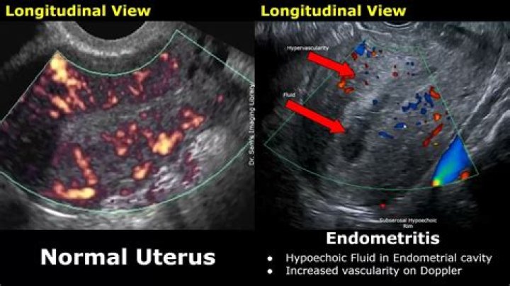 What is inflammation of the uterus