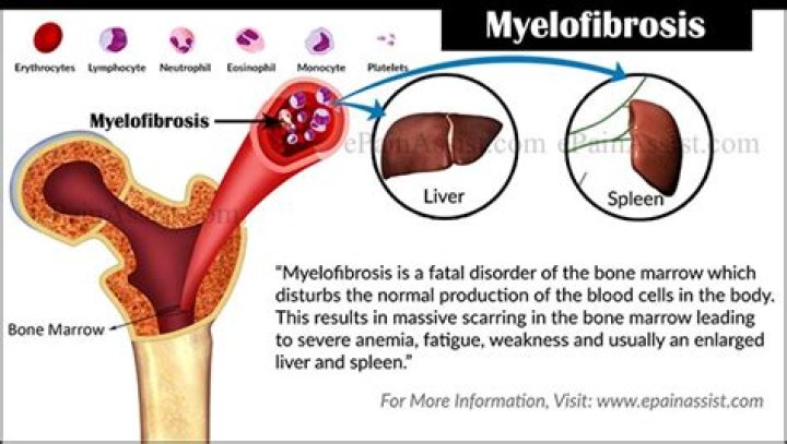 What is myelofibrosis disease