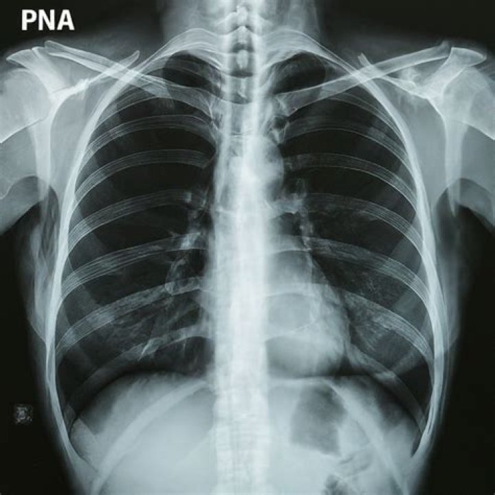What is PNA medical
