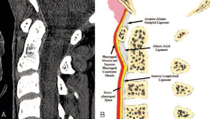 What is Prevertebral soft tissue