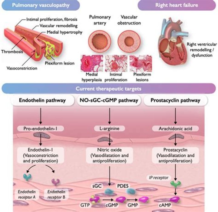 What is the best medication for pulmonary hypertension