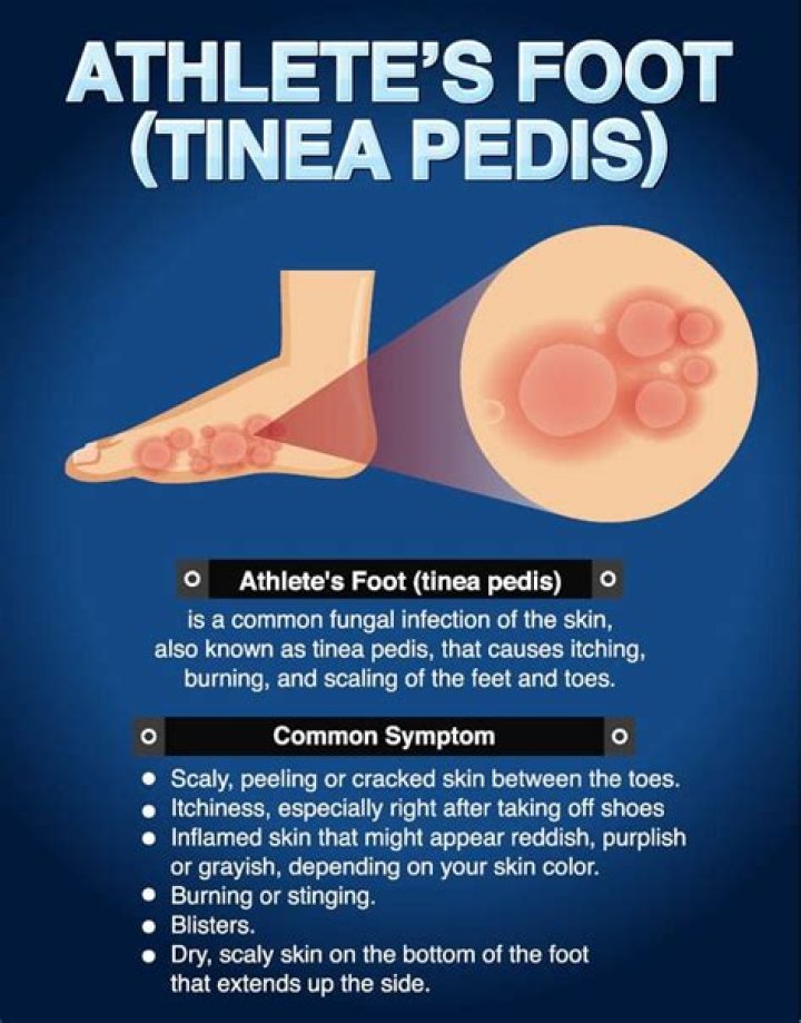 What is the best over the counter medicine for athletes foot