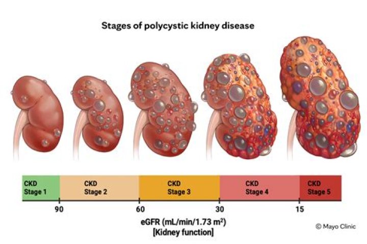 What is the code for congenital cystic kidney disease