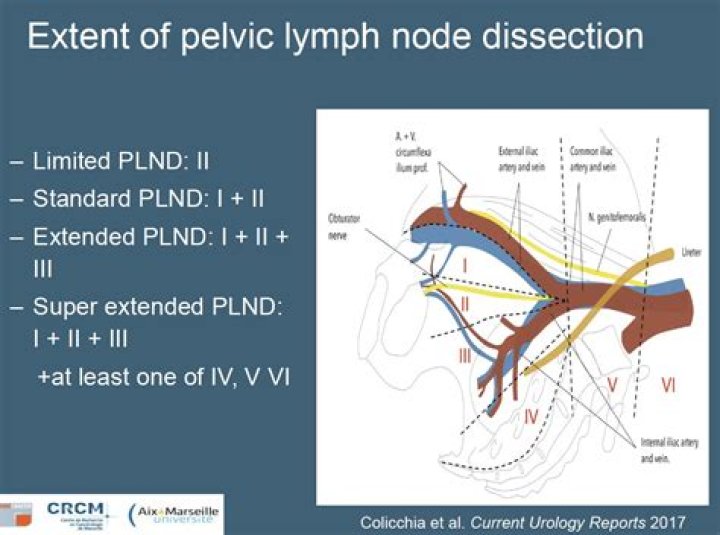 What is the CPT code for pelvic lymph node dissection