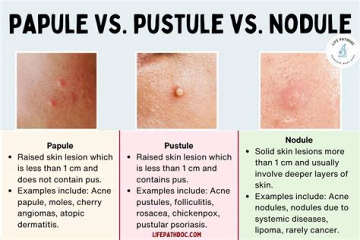 What is the difference between a nodule and a papule