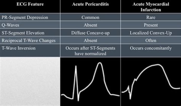 What is the difference between acute and chronic pericarditis?