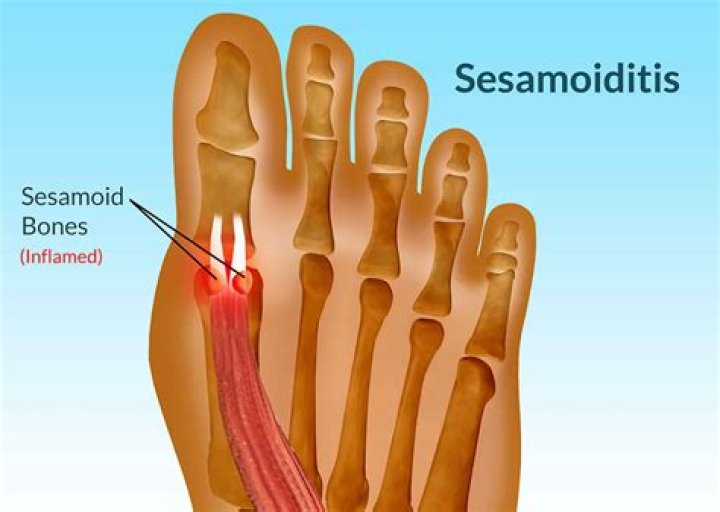 What is the function of a sesamoid bone?