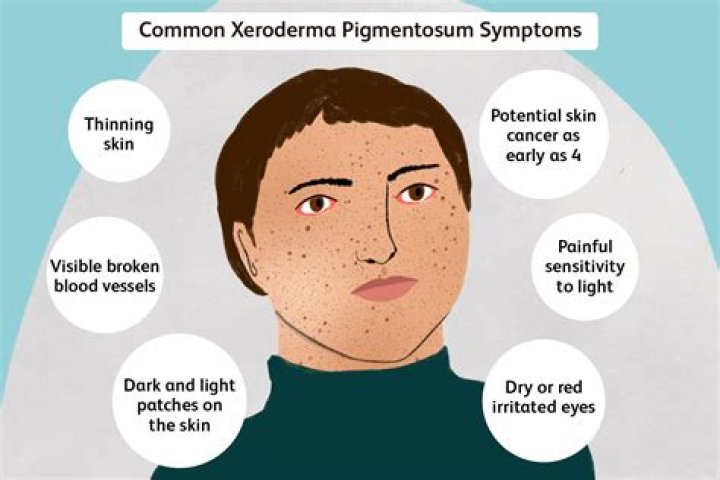 What is the life expectancy of someone with xeroderma pigmentosum