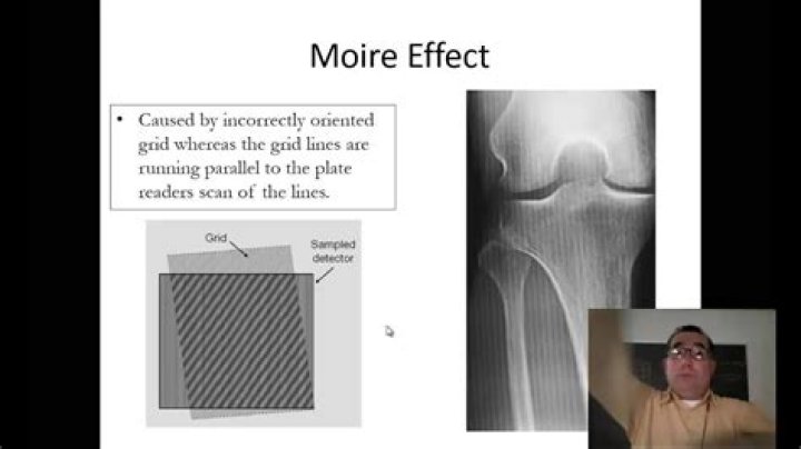 What is the moire effect in radiography