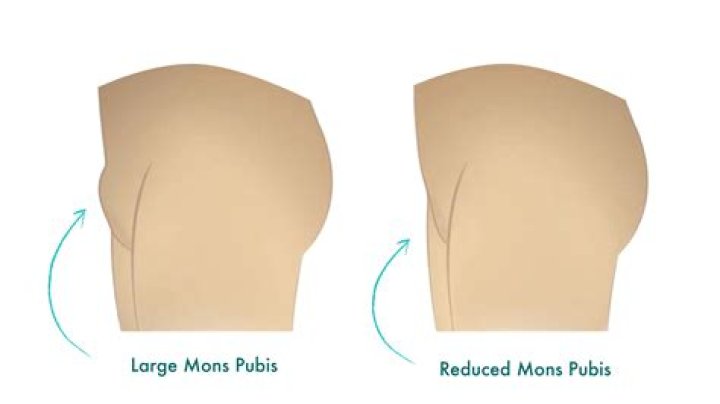 what is the pubic mound