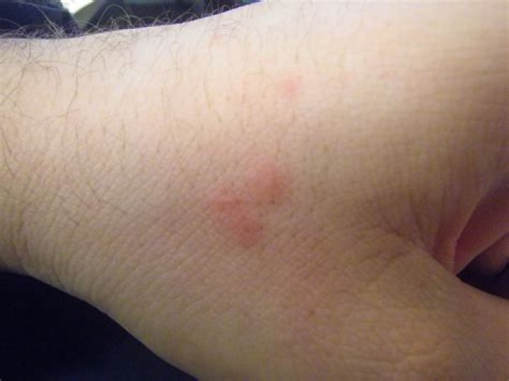 What other bites look like bed bug bites