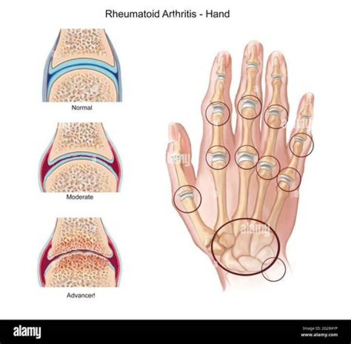 What part of the hand is affected by rheumatoid arthritis?