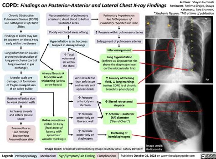 What physical findings might be indicative of a patient with emphysema