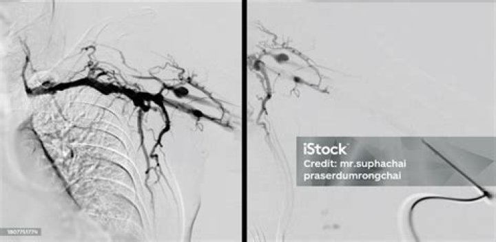 which endovascular procedure reopens narrowed blood vessels?