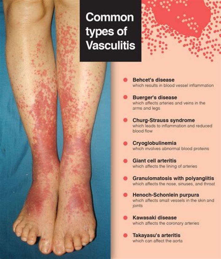 Which vasculitis is ANCA positive?