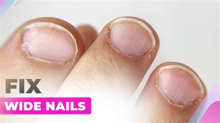 Why are my nails very thin?
