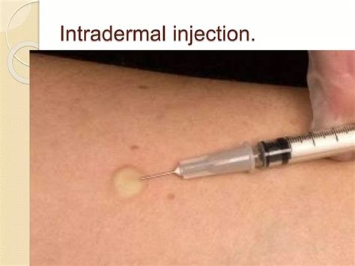 Why is intradermal injection used