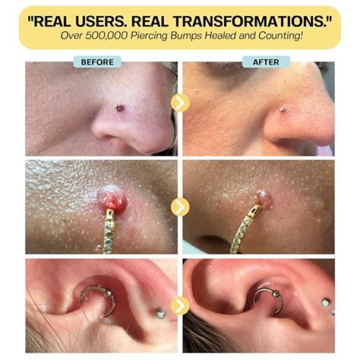 Will a nose piercing bump go away on its own?